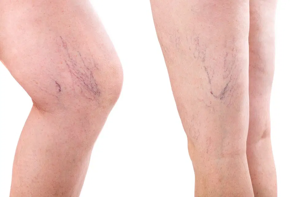 How Are Spider Veins Treated?