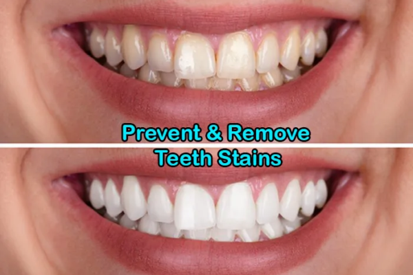 Can Teeth Whitening Remove Stains?