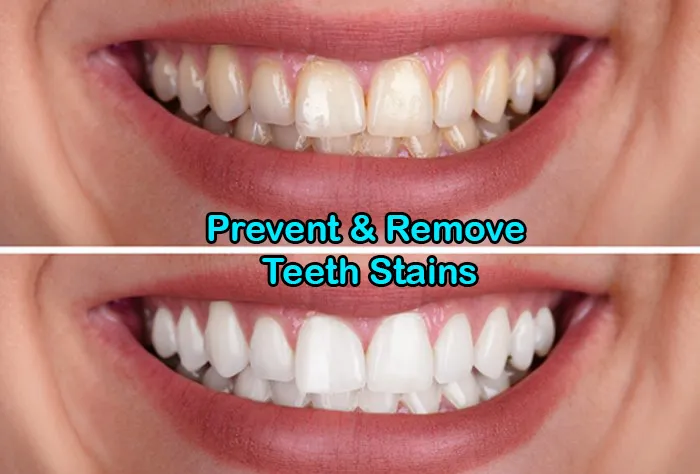 Can Teeth Whitening Remove Stains?