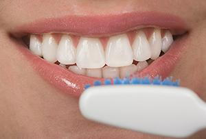 FAQs About Dental Veneers